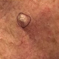 Squamous Cell Carcinoma, Skin Cancer Center of CT