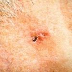 Basal Cell Carcinoma - Skin Cancer Center of CT