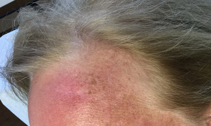 After mohs surgery and treatment of skin cancer by Dr. Herbst - Skin Cancer Center of CT