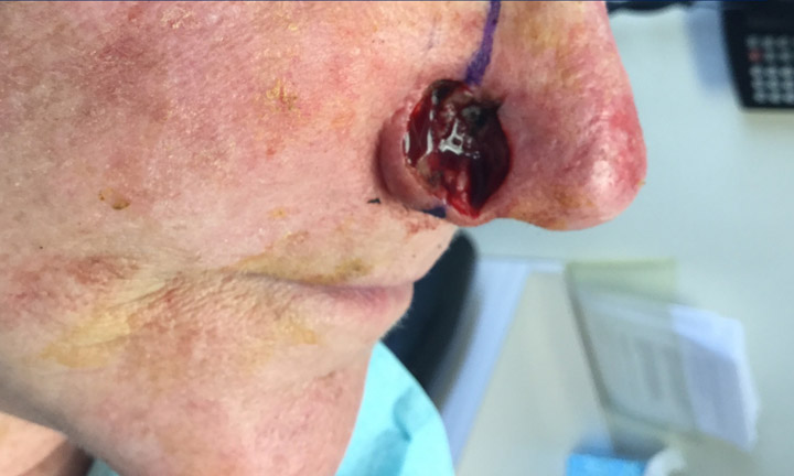 Before photo of a patient with skin cancer before mohs surgery - Skin Cancer Center of CT