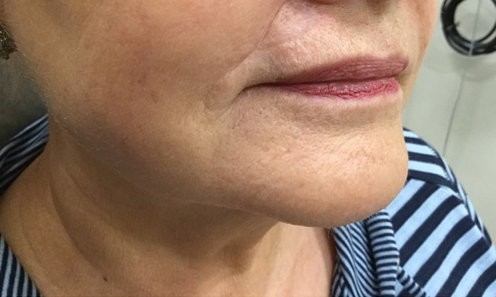 After photo of mohs surgery skin cancer treatment - Dr. Herbst, Skin Cancer Center of CT