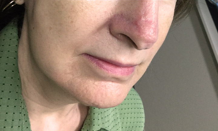 After mohs surgery skin cancer treatment by Dr. Herbst - Skin Cancer Center of CT