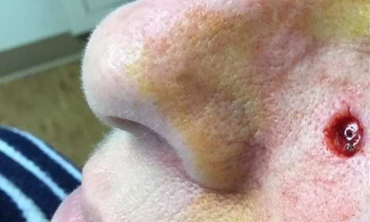 Before photo of Dr. Herbst patient - Skin Cancer Center of CT