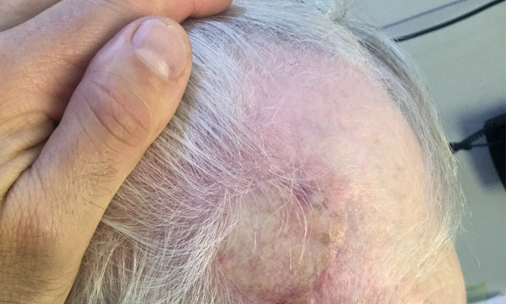 A patient's head after moh's surgery skin cancer treatment by Dr. Herbst - Skin Cancer Center of CT